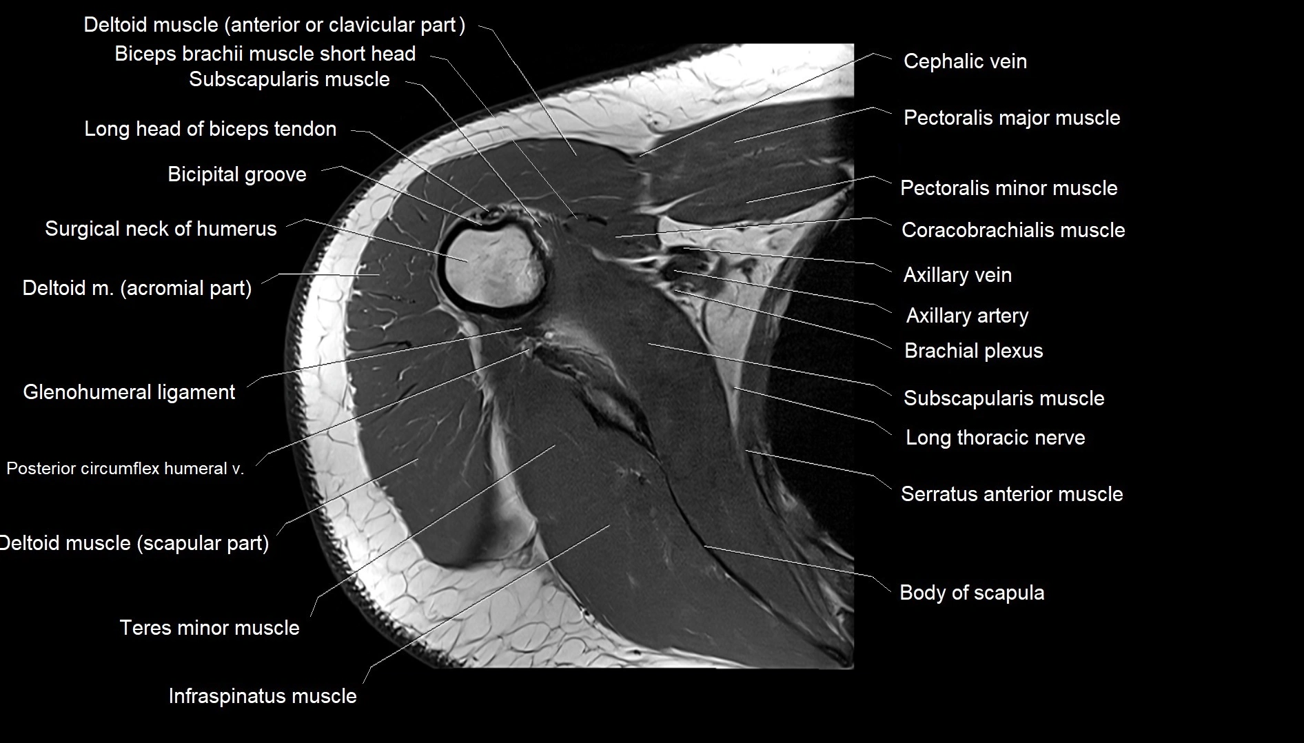 Shoulder cross sectional anatomy MRI 3T axial image 27.webp